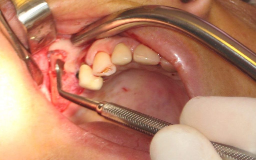 Tam Ağız Diş implantları Full Mouth Porselen Diş Hekim Konyaaltı Antalya