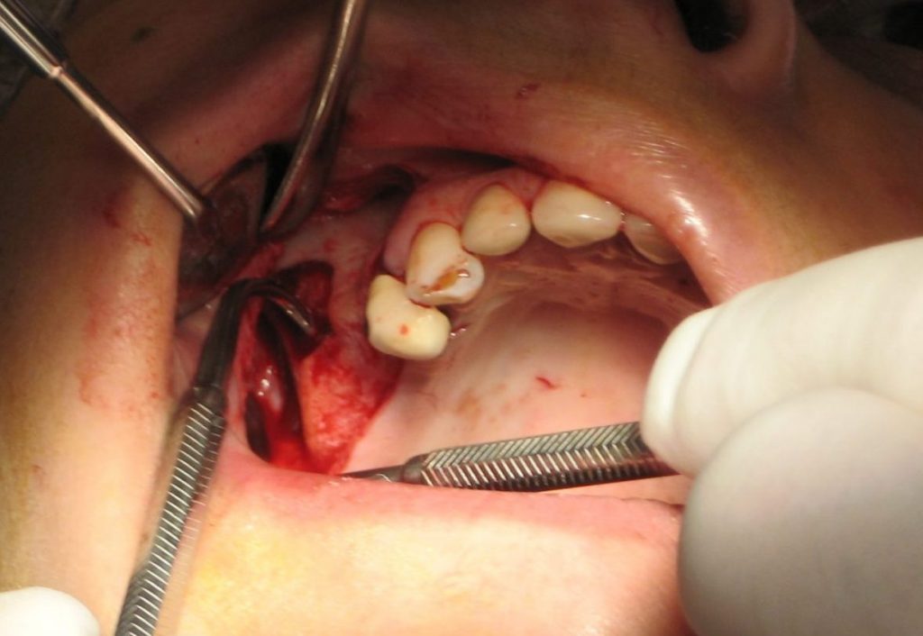 Tam Ağız Diş implantları Full Mouth Porselen Diş Hekim Konyaaltı Antalya
