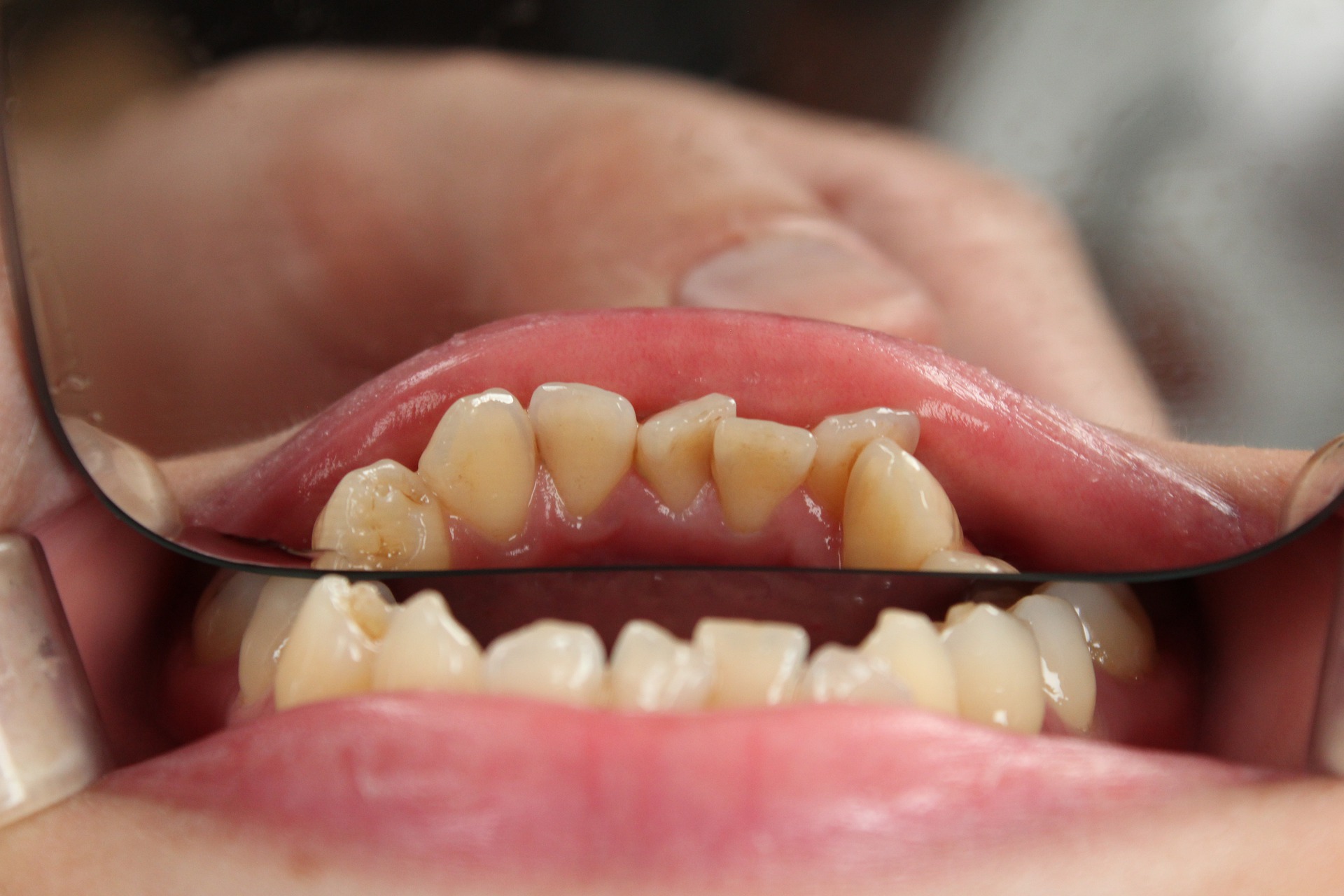 Diş Temizliği Nedir Nasıl Yapılır Acıtır mı Konyaaltı Antalya implant