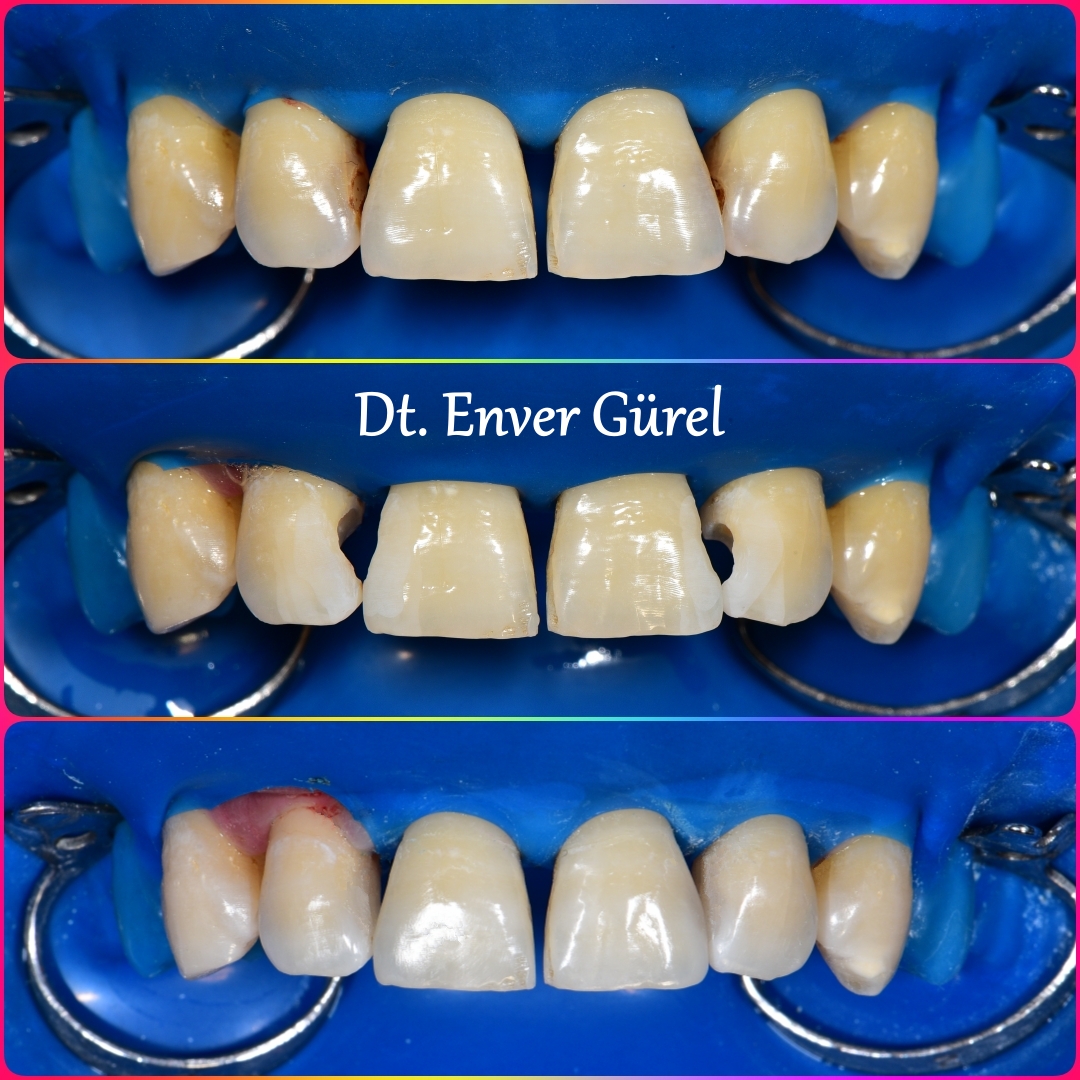 Galeri Fotoğraflar Videolar Diş Hekimi Konyaaltı implant porselen